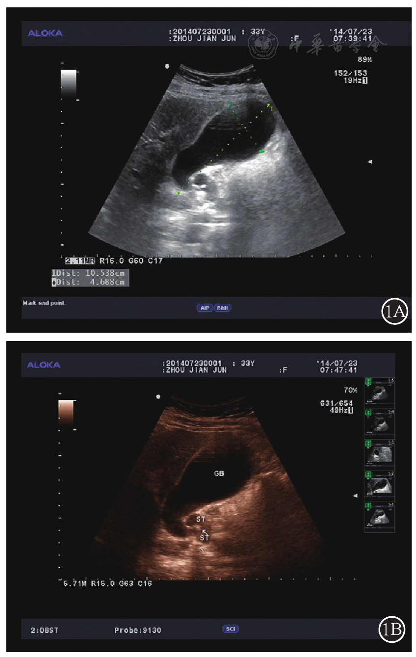 胆囊颈部结石超声诊断影像学分析
