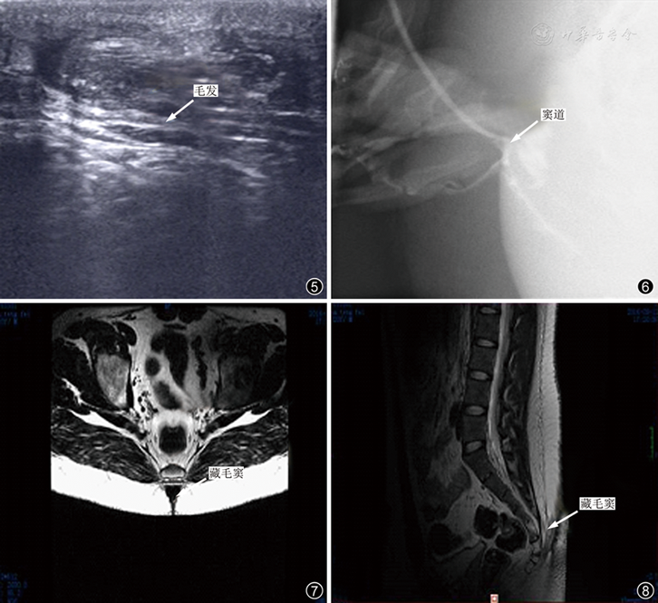 图5 彩超示藏毛窦为低回声区域或管道,内可见毛发 图6 窦道造影 图7