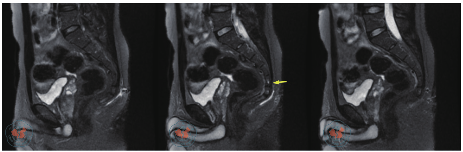 骶尾部藏毛窦术后复发并发骶尾骨骨髓水肿一例
