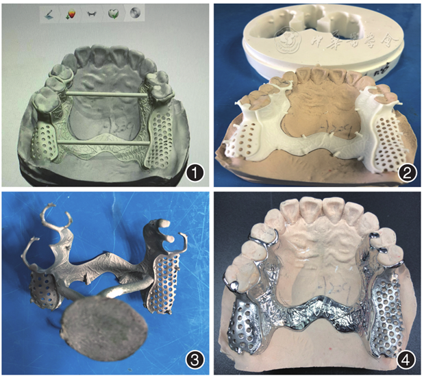 cad/cam切削技术在可摘局部义齿支架制作中的应用