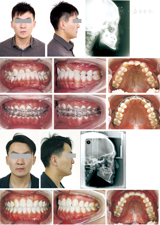 恒牙期唇腭裂患者上颌宽度不足的管控