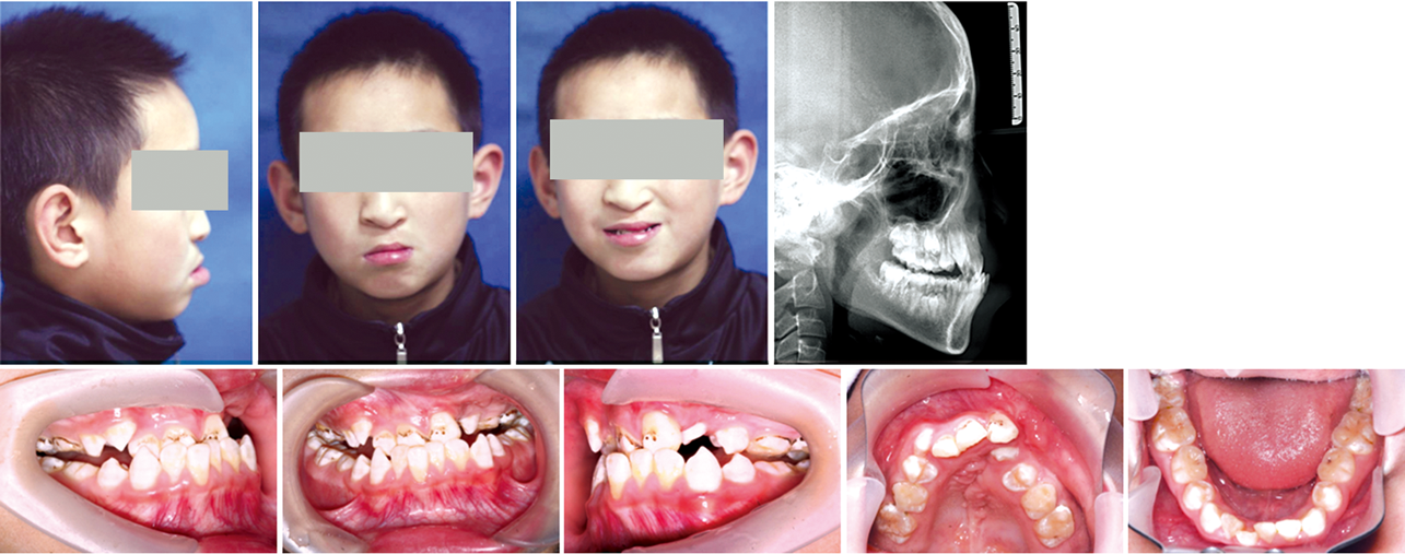 1例唇腭裂植骨术后错畸形的正畸治疗