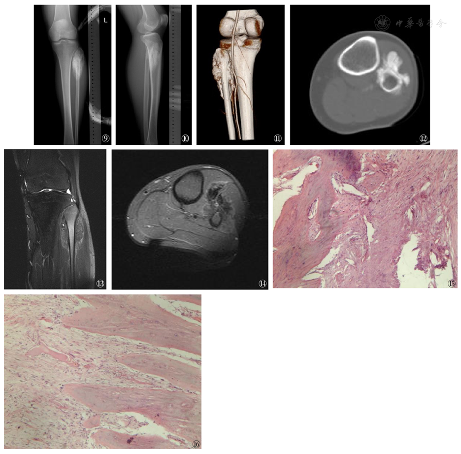 图9~10 胫腓骨中上段正侧位平片示:腓骨干骺端可见不规则高密度肿瘤骨