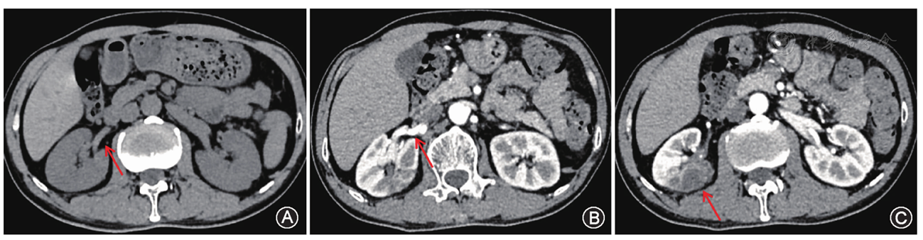 自发性肾动脉夹层并肾梗死一例报告
