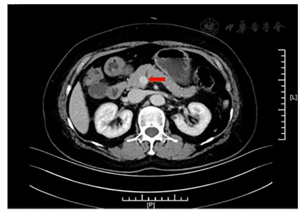 注:红色箭头所指,胰头钩突区小结节影 患者胰腺动态增强计算机