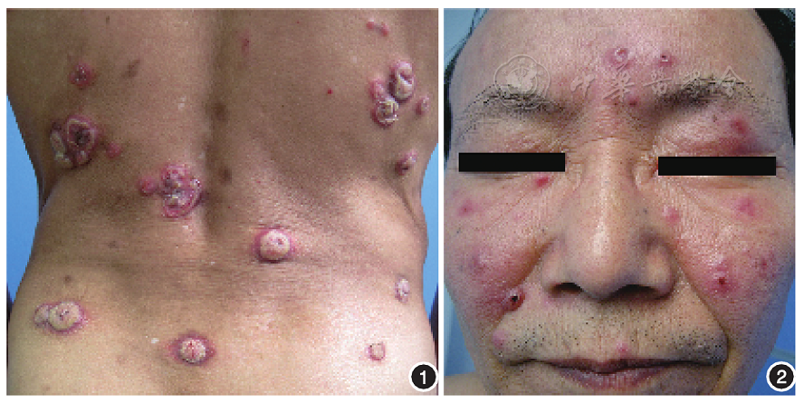 表现特殊的二期梅毒疹二例 - 中华皮肤科杂志