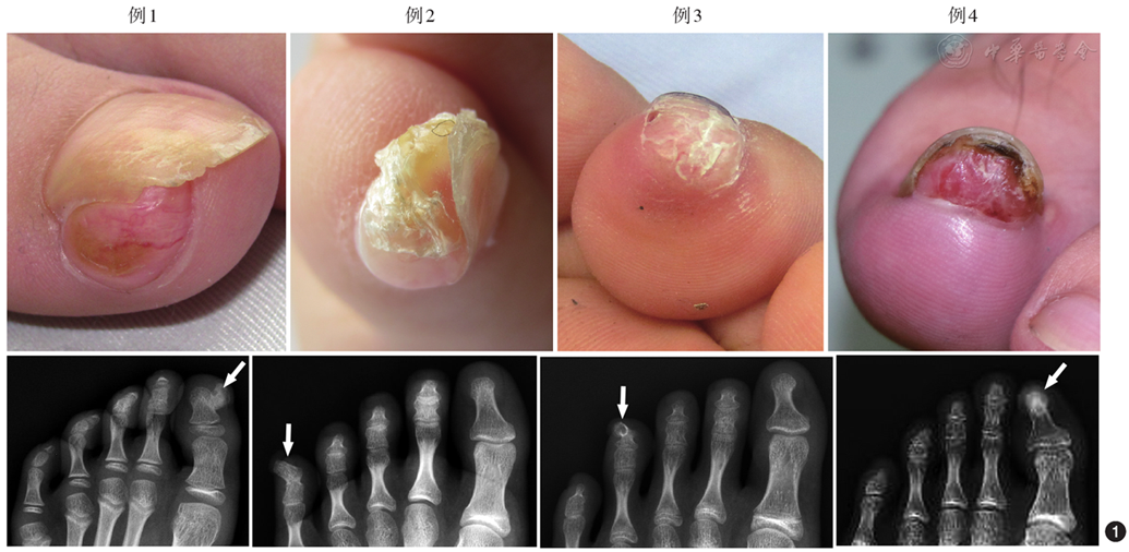 儿童甲下外生性骨疣四例