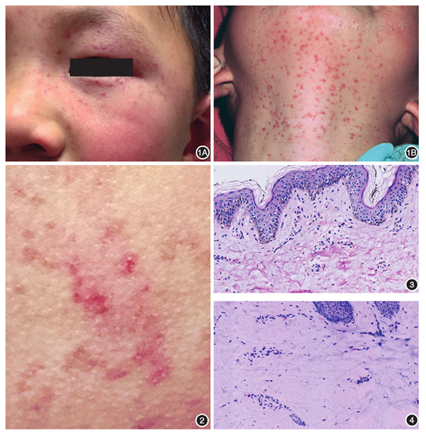 儿童持久性发疹性斑状毛细血管扩张症一例