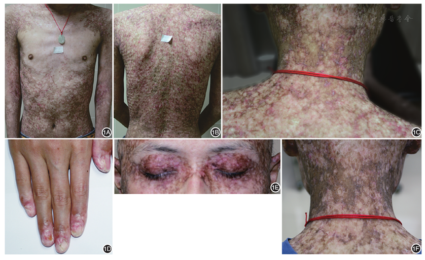 图1 患者皮疹表现 1a ~ 1c:全身对称分布网状色素沉着斑及斑片,伴有