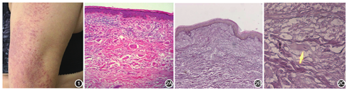 丘疹型环状弹性纤维溶解性巨细胞肉芽肿一例