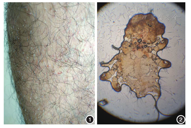 双小腿部阴虱一例