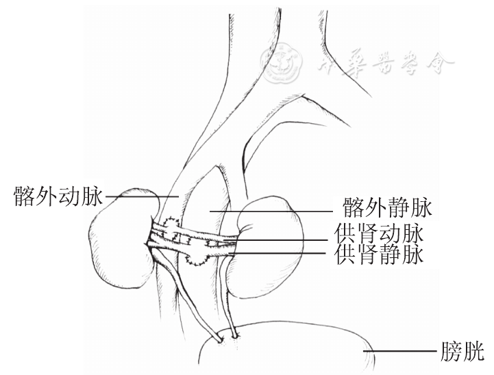 婴儿双供肾成人肾移植的14例报告及手术技术改进