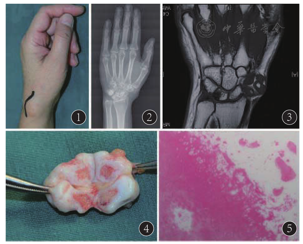 腕部骨外(软组织)软骨瘤一例
