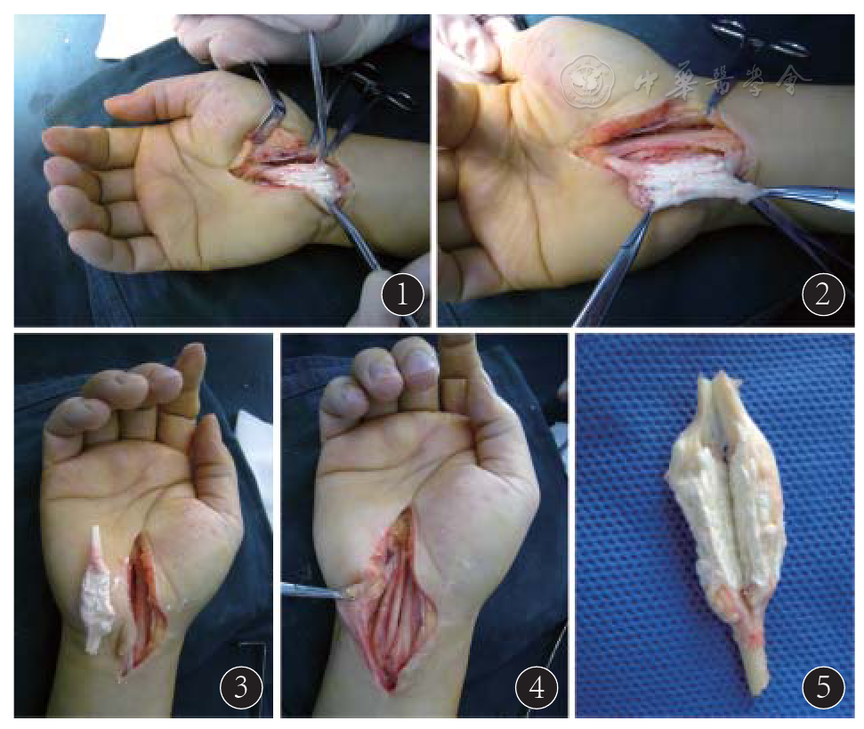 图2 切开肌腱外膜,痛风石破坏肌腱 图3 切除此段肌腱 图4 腕管内其他