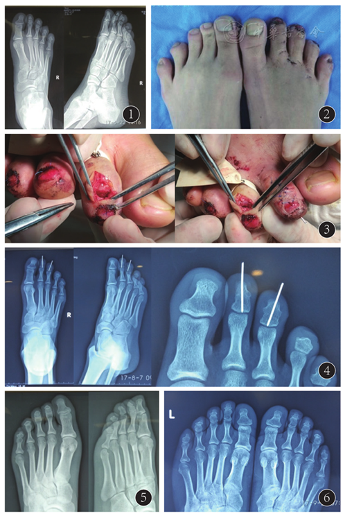 右足足趾全为两节趾骨伴骨折一例