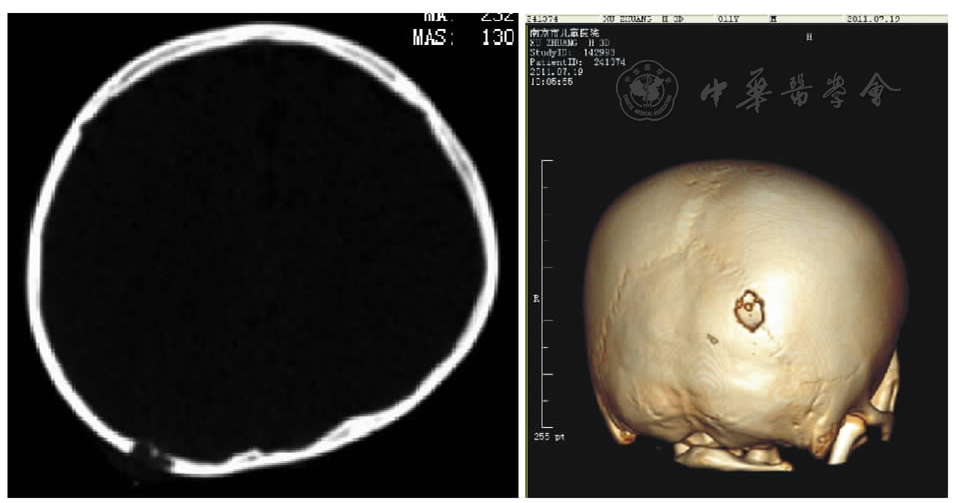 5 cm骨质缺损,软组织密度肿块,可见颅骨破坏呈"双箭头征" figure 1