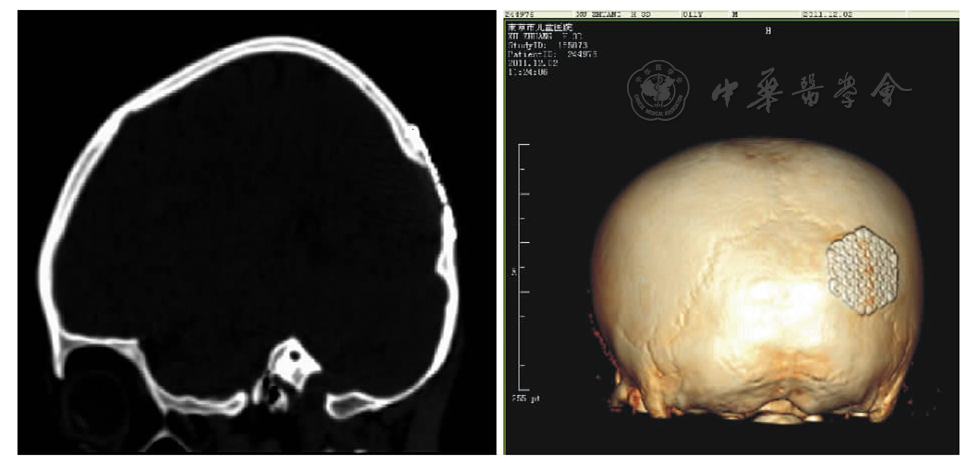 图2 扩大切除并行颅骨修补术后ct表现 figure 2 postoperative ct