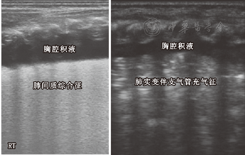 性呼吸增快症与呼吸窘迫综合征的超声鉴别:两图均显示大量胸腔积液