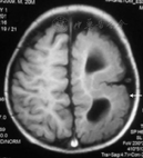 脑裂畸形35例患儿临床影像学特征及随访研究