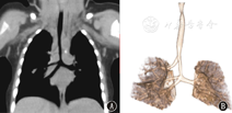 儿童先天性支气管桥畸形临床与解剖形态分析