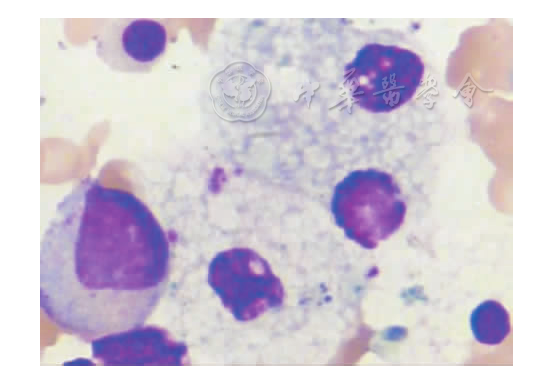 图4 例2尼曼匹克病患儿尼曼匹克细胞(瑞士-吉姆萨染色,×1 000)