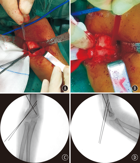 改良肱骨髁上阶梯截骨技术治疗儿童肘内翻畸形