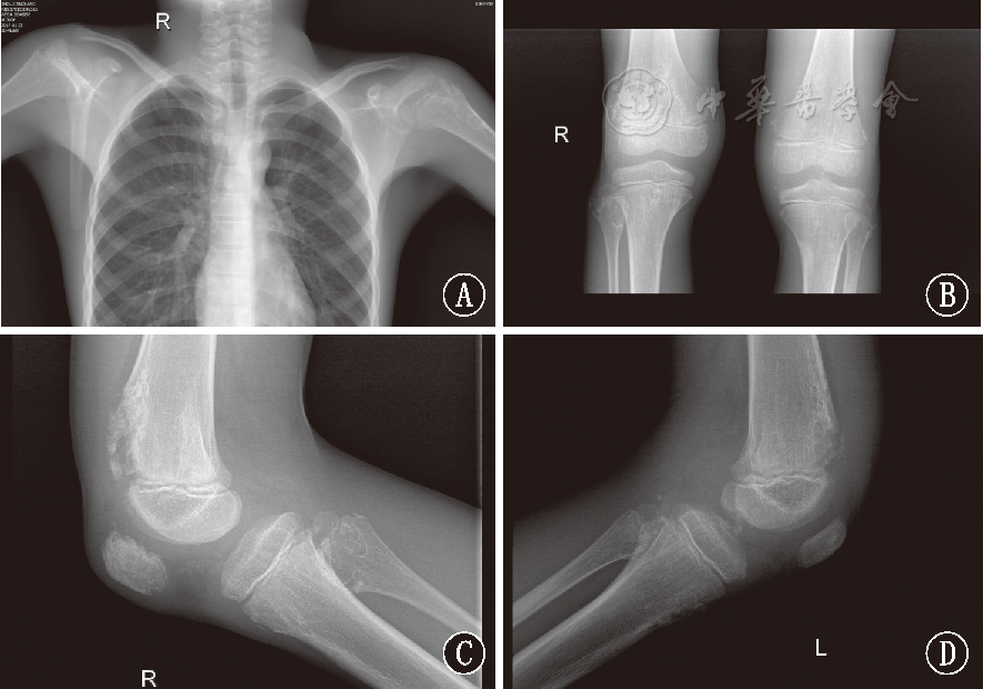 儿童多发性对称性内生软骨瘤病1例