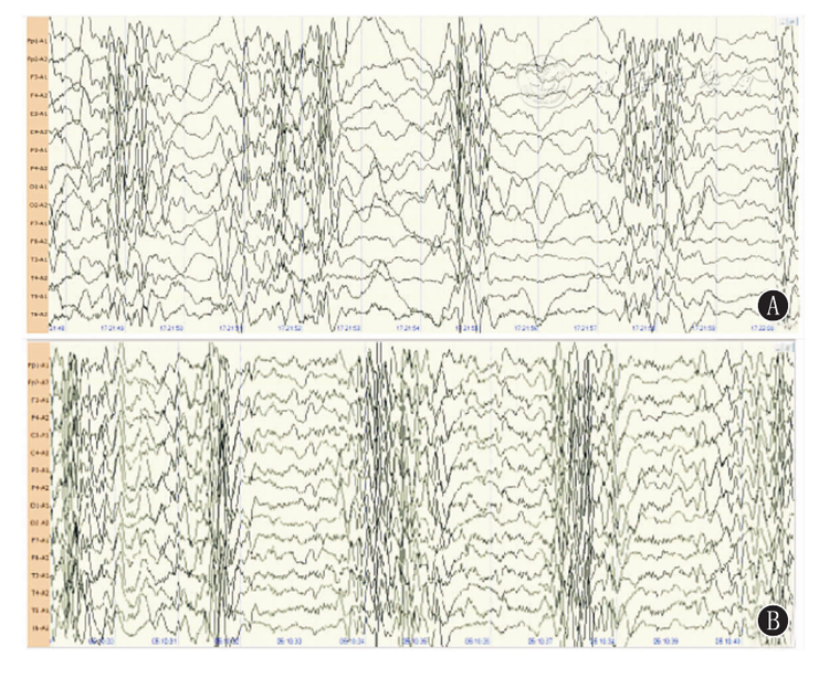 有助于对is临床表型的 图2 婴儿痉挛症患儿2例脑电图 a:先证者;b:先