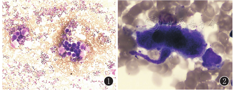  100×10图1 骨髓巨核细胞增生明显活跃(×100) 图2 巨核细胞产板不良