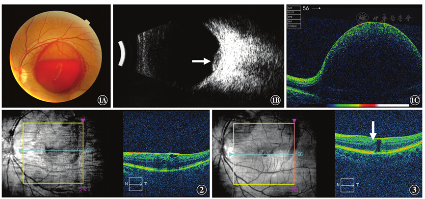 valsalva视网膜病变合并黄斑病变一例