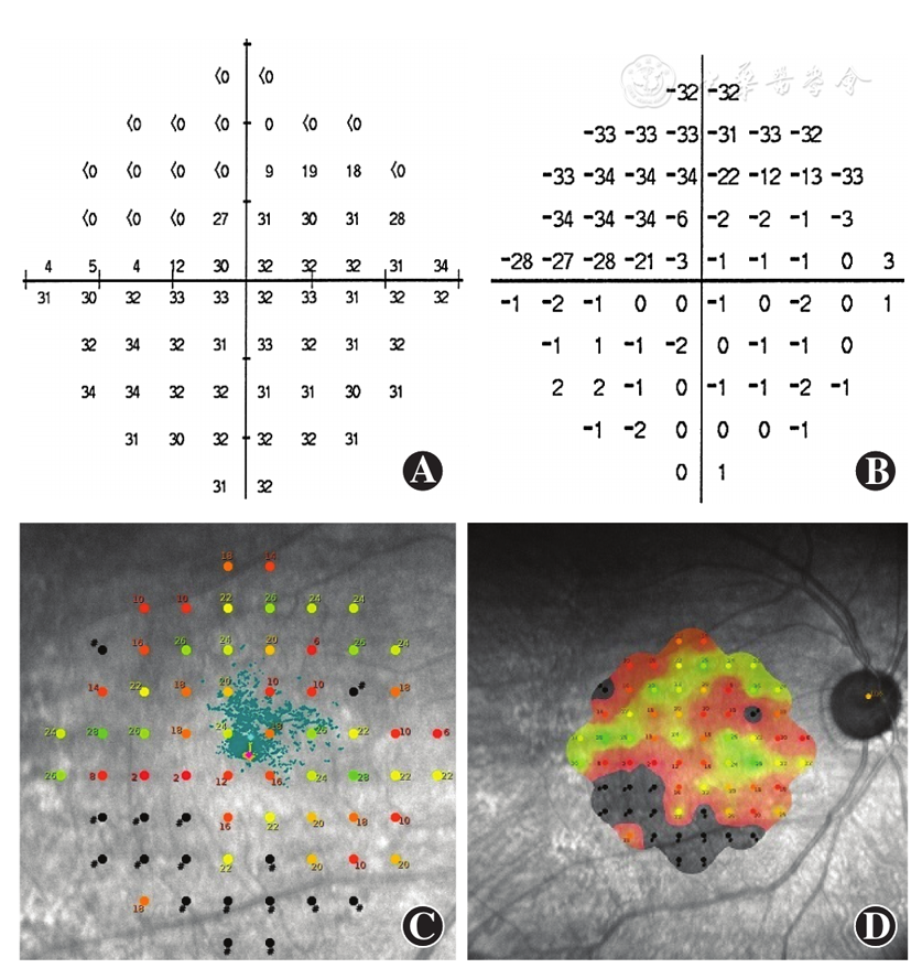 微视野计对半侧视野损害的青光眼固视稳定性改变的评估价值