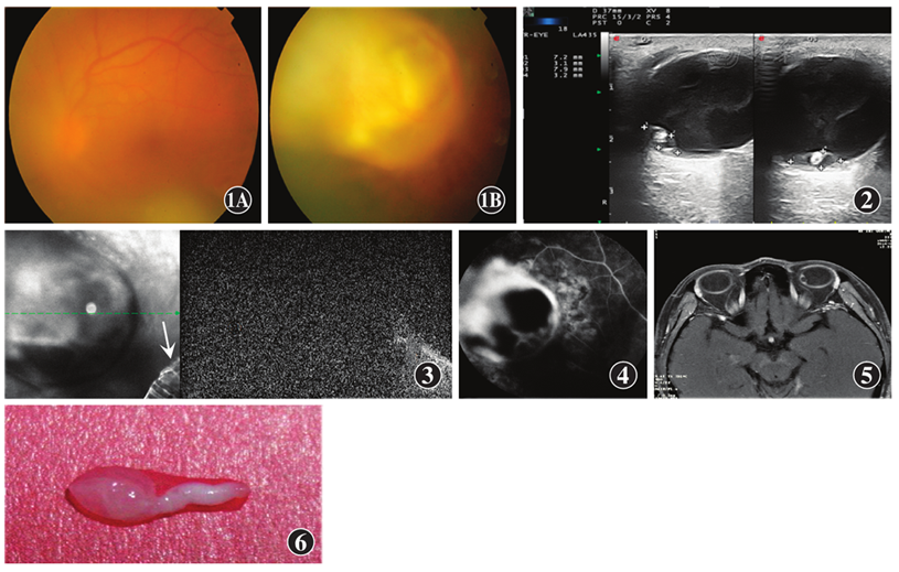 视网膜下囊尾蚴一例 - 中华实验眼科杂志