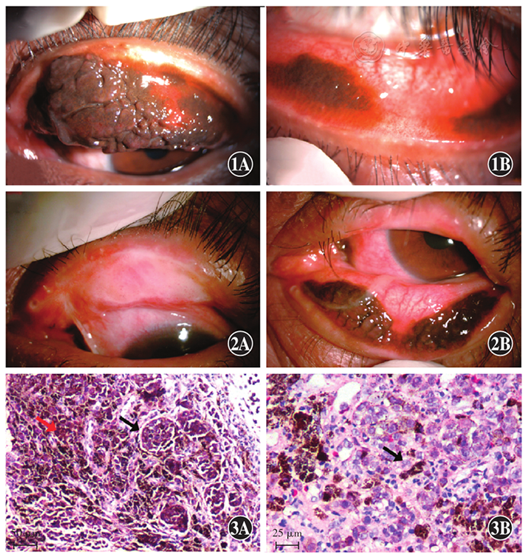 睑结膜恶性黑色素瘤诊疗一例