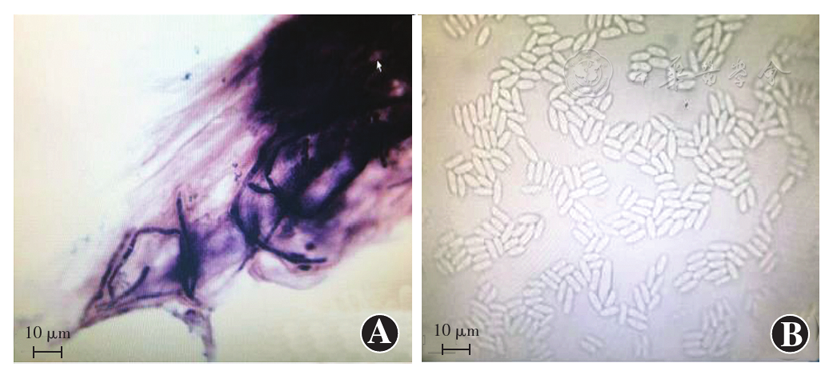 000,标尺=10 μm,革兰染色) 可见大量真菌菌丝 b:真菌菌株培养鉴定