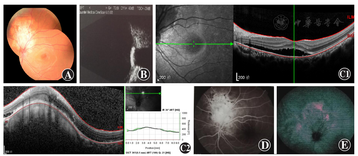 b:b型超声检查示视盘区轻度隆起的高反射灶 c:oct示左眼黄斑区及视盘
