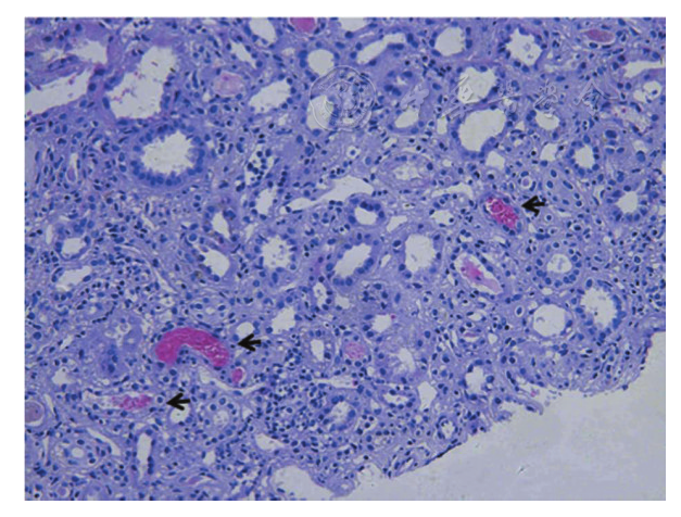 注:"←"示肾小管内红细胞管型     肾穿刺活检病理(he染色 ×200)