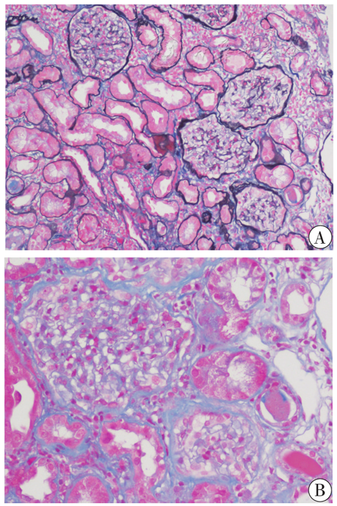 注:a:pasm masson染色×100;b:masson染色×200     患者肾活检光镜