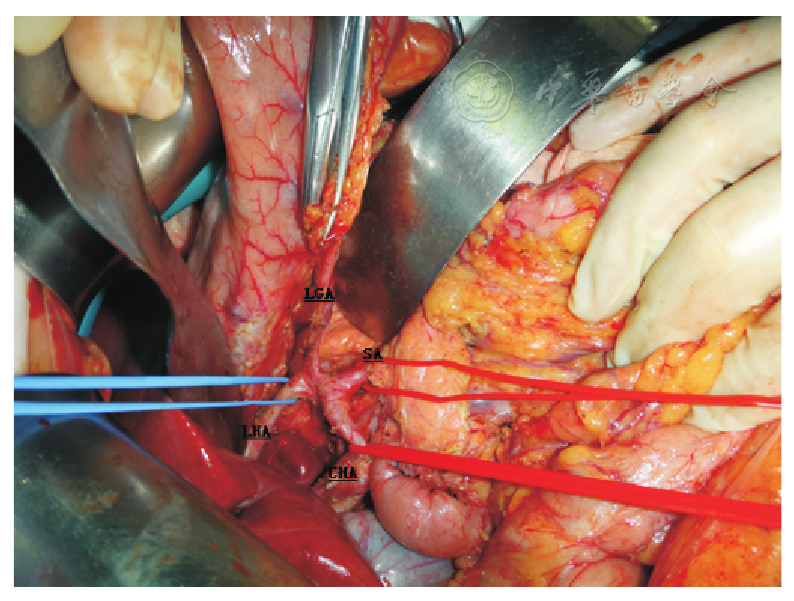 腹腔动脉h型分支变异一例