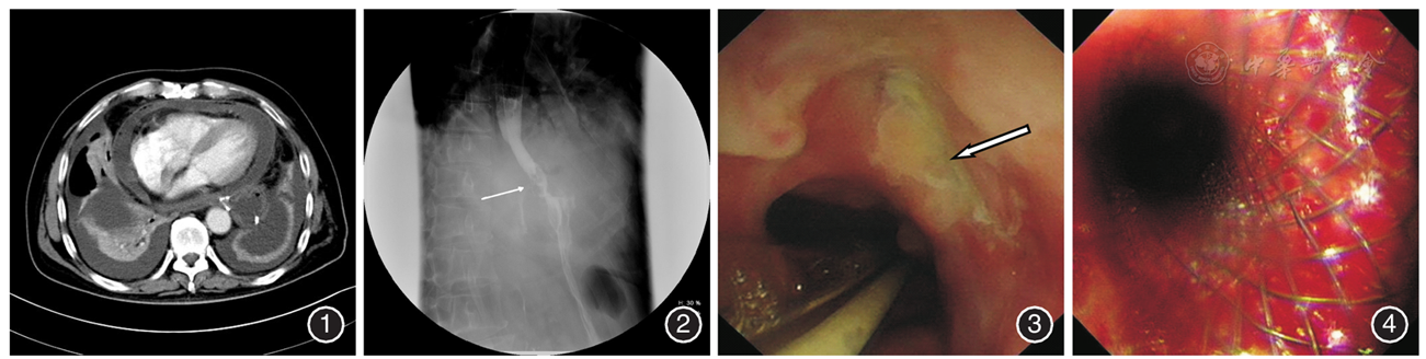 贲门癌术后食管心包瘘救治成功一例
