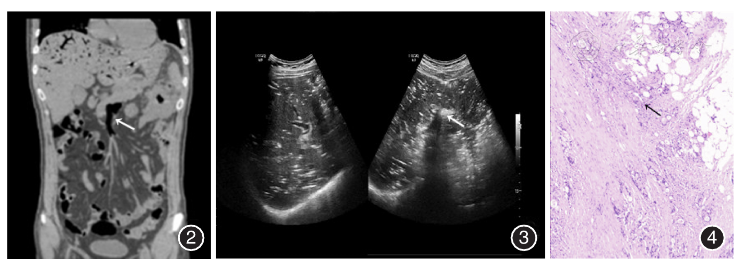 图2 ct冠状面,肠系膜上静脉内见气体密度影(白箭头所示) 图3 腹部超声