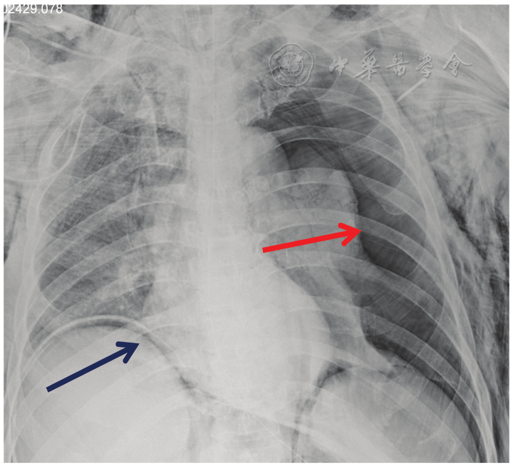注:红色箭头所示左胸气胸,蓝色箭头所示隔游离气体     病例3患者胸片