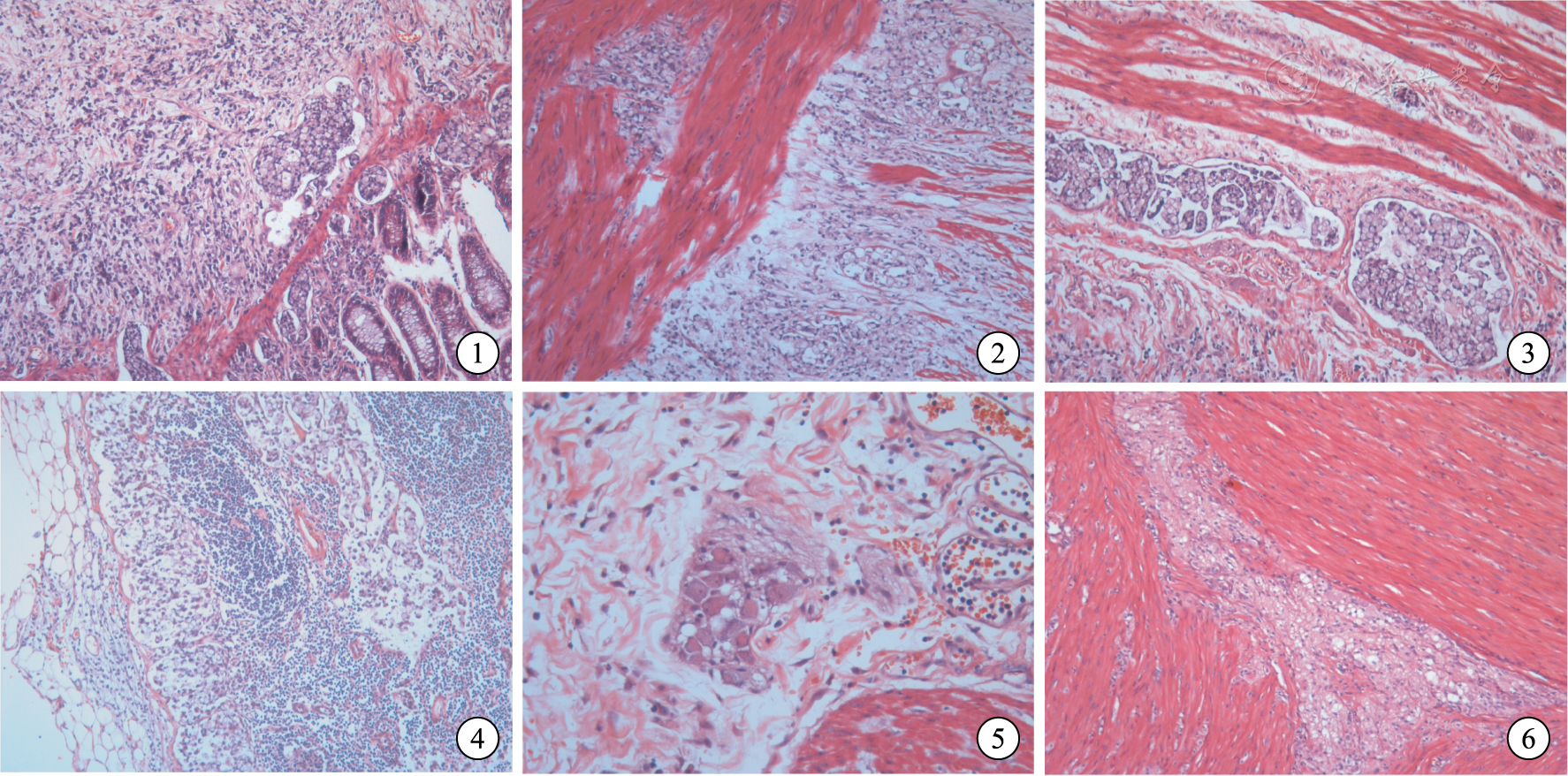 图1 印戒细胞及未分化小细胞弥漫浸润结肠浆膜层和黏膜下层((he