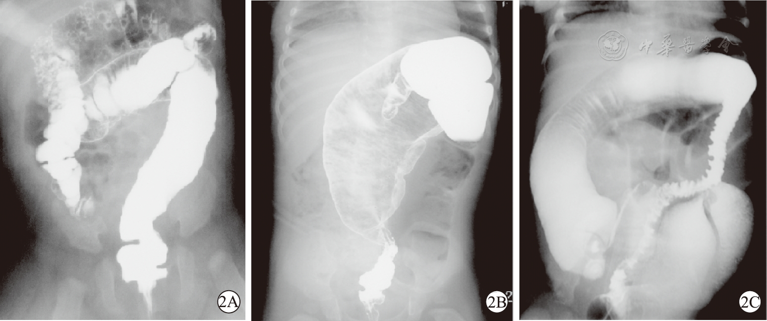 钡灌肠检查在诊断先天性巨结肠及明确肠管病变范围中的应用价值
