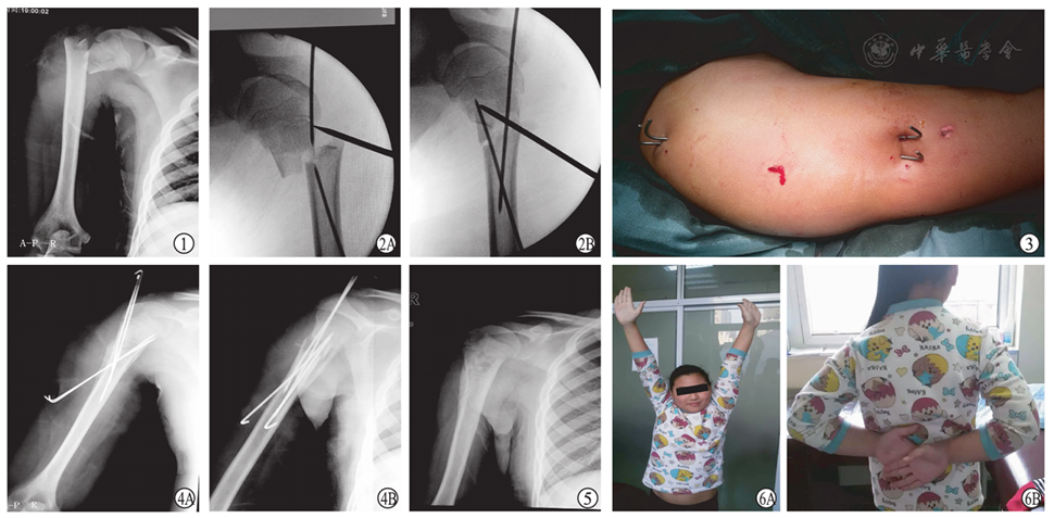 经皮撬拨克氏针固定治疗大龄儿童"不可复性"肱骨近端骨折