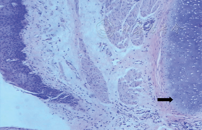 注:箭头指示软骨组织     气管软骨食管异位的病理结果(he,×40)
