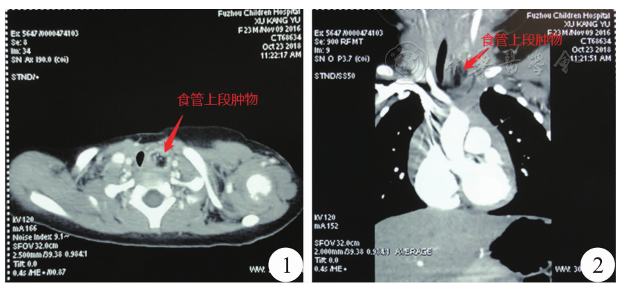 图1 患儿胸部ct平扫示食管上段走行区团块影(箭头处) 图2 患儿胸部ct