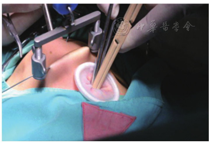 图1 悬吊腹腔镜手术操作示意图,用悬吊器械将上腹壁悬吊,在疝孔投影