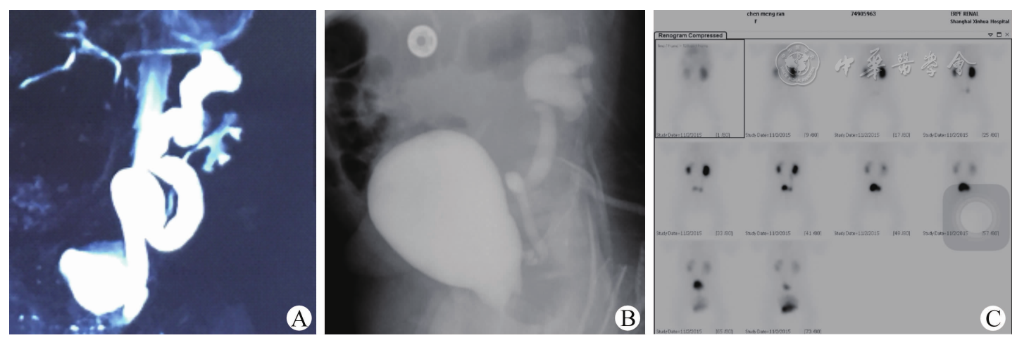 排泄性膀胱尿道造影显示左下肾部膀胱输尿管反流;c.