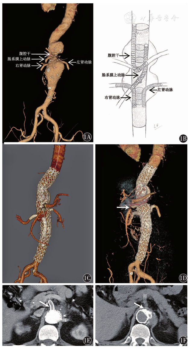 复合支架技术全腔内修复胸腹主动脉瘤及三年随访一例