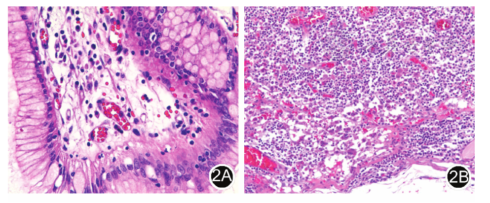 he染色 中倍放大 2a:胃黏膜充血水肿,黏膜浅层固有膜间质内可见淋巴